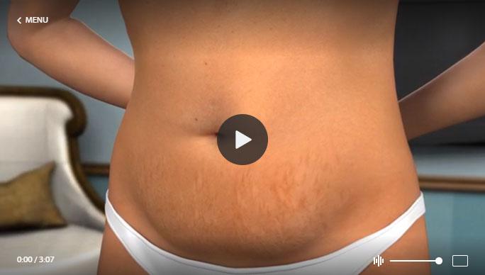 Does Mini Tummy Tuck Lower The Belly Button