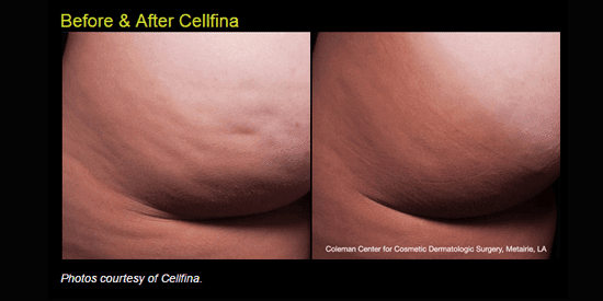 Learn more about Cellfina at our Idaho Falls plastic surgery practice