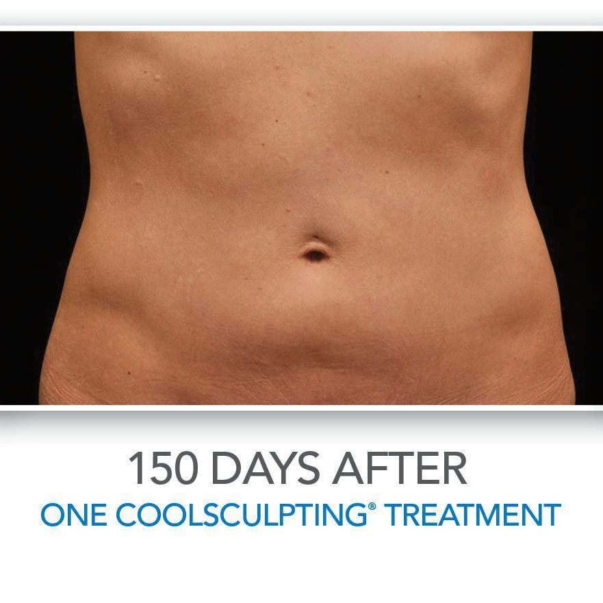 CoolSculpting Before & After Photos