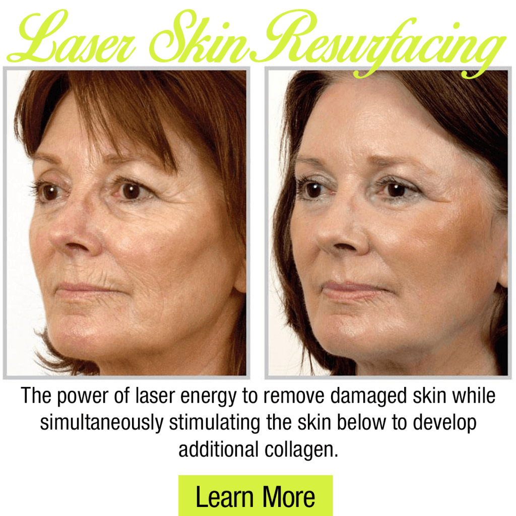 Woman before and after laser skin resurfacing