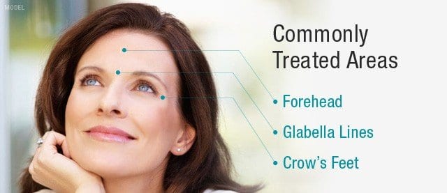 Woman smiling with text that reads BOTOX treatment areas: forehead, glabella lines, crow\'s feet