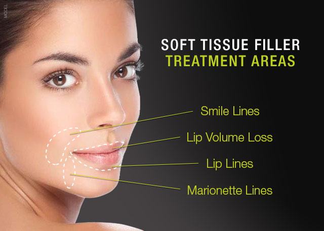 Woman smiling with text that reads soft tissue filler treatment areas: smile lines, lip volume loss, lip lines, marionette lines