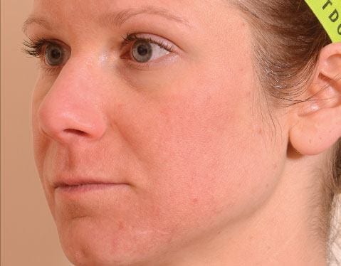 After Halo laser on woman\'s face