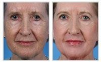 Before and after laser skin resurfacing on woman\'s face