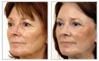 Before and after laser skin resurfacing on woman\'s face