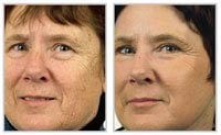 Before and after laser skin resurfacing on woman\'s face