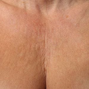 Before Ultherapy on chest