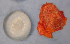 A new breast implant displayed next to a breast plant encased in a scar capsule