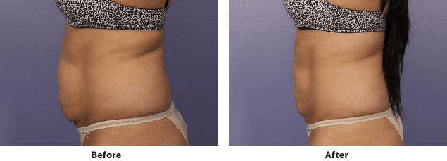 Side view of CoolSculpting before and after on the abdomen of a female patient