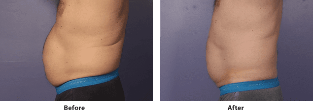 Side view of CoolSculpting before and after on the abdomen of a male patient