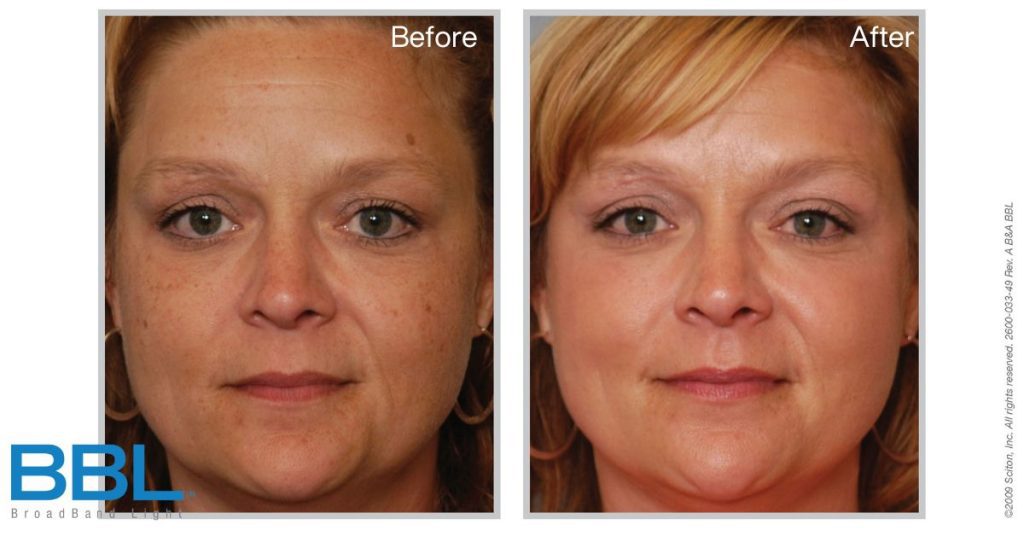Before & After of woman who received BBL treatment. Photo provided by the manufacturer.
