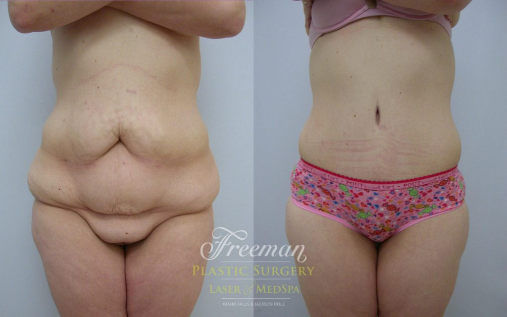 Before and After of actual tummy tuck patient.