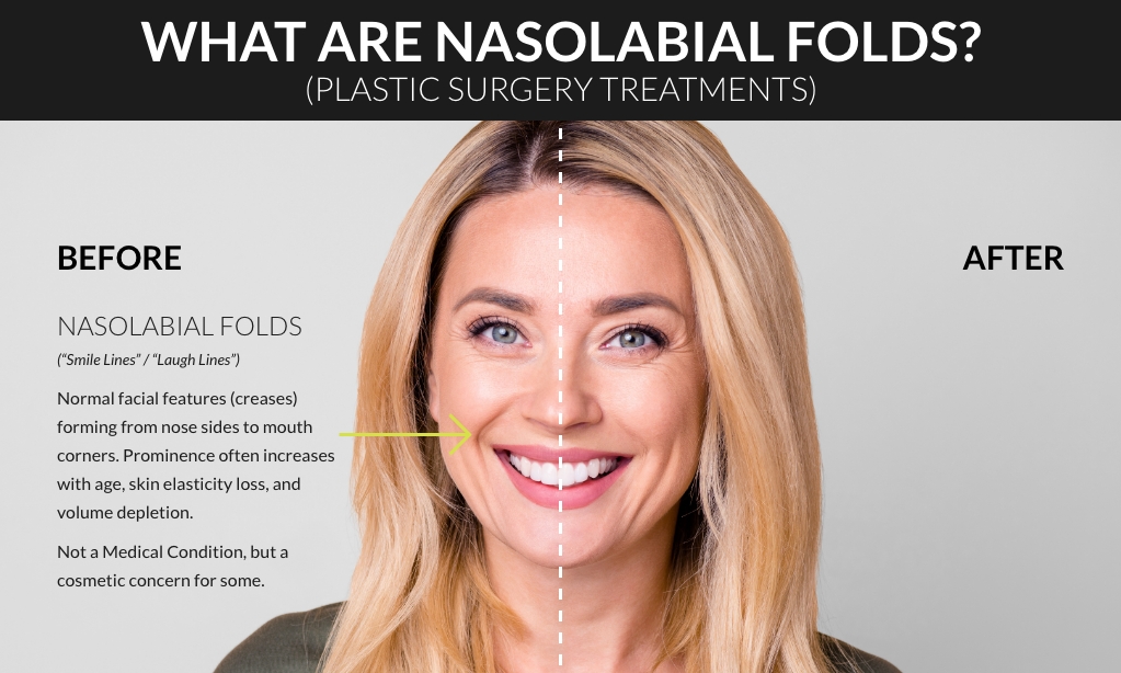 Infographic explaining nasolabial folds, also known as smile lines or laugh lines, with a split before-and-after image of a smiling blonde woman showing reduced facial creases after cosmetic treatment. The graphic describes nasolabial folds as natural facial creases that can become more prominent with age, skin elasticity loss, and volume depletion. (Model)